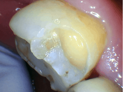 Inside a broken tooth